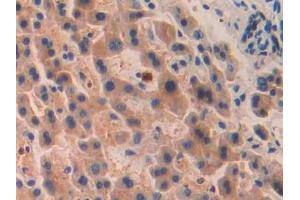 DAB staining on IHC-P; Samples: Human Liver cancer Tissue (PITRM1 antibody  (AA 544-806))