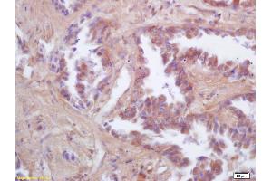 Formalin-fixed and paraffin embedded human lung carcinoma labeled with Rabbit Anti FIS1/TTC11 Polyclonal Antibody, Unconjugated (ABIN872461) at 1:200 followed by conjugation to the secondary antibody and DAB staining (Fission 1 antibody  (AA 55-152))