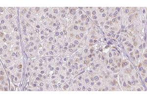 ABIN6277329 at 1/100 staining Human melanoma tissue by IHC-P. (CFHR1 antibody  (C-Term))