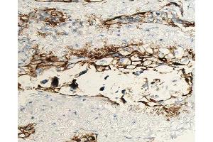 ABIN6277014 at 1/100 staining human lung carcinoma tissue sections by IHC-P. (ANGPTL4 antibody  (N-Term))