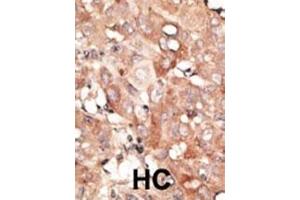 Formalin-fixed and paraffin-embedded human cancer tissue reacted with the primary antibody, which was peroxidase-conjugated to the secondary antibody, followed by DAB staining. (RGS19 antibody  (N-Term))