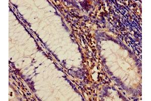 Immunohistochemistry of paraffin-embedded human colon cancer using ABIN7150034 at dilution of 1:100 (A Disintegrin and Metallopeptidase Domain 1a (ADAM1A) (AA 214-504) antibody)