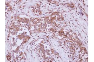 IHC-P Image Immunohistochemical analysis of paraffin-embedded human breast cancer, using P2X7, antibody at 1:250 dilution. (P2RX7 antibody  (Center))