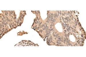 Immunohistochemistry of paraffin-embedded Human colorectal cancer tissue using ZSCAN12 Polyclonal Antibody at dilution of 1:50(x200) (ZSCAN12 antibody)