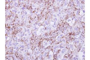 IHC-P Image G6PD antibody detects G6PD protein at cytosol on human breast cancer by immunohistochemical analysis. (Glucose-6-Phosphate Dehydrogenase antibody)