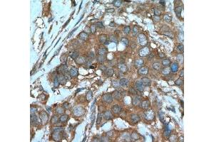 IHC analysis of paraffin-embedded human breast cancer tissue using Beclin 1 antibody at a dilution of 1:200. (Beclin 1 antibody)