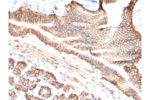 Formalin-fixed, paraffin-embedded human Pancreatic Carcinoma stained with TACSTD2 / TROP2 Mouse Monoclonal Antibody (TACSTD2/2151).