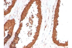 Formalin-fixed, paraffin-embedded human Prostate Carcinoma stained with TIGIT-Monospecific Mouse Monoclonal Antibody (TIGIT/3017). (TIGIT antibody  (AA 22-141))
