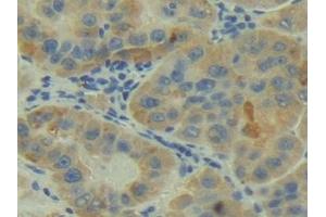 Detection of C2 in Human Liver cancer Tissue using Polyclonal Antibody to Complement Component 2 (C2) (Complement C2 antibody  (AA 245-451))