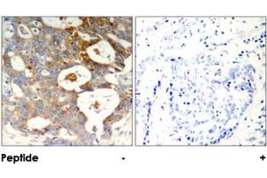 Immunohistochemical analysis of paraffin-embedded human breast carcinoma tissue using NFKBIE (phospho S22) polyclonal antibody . (NFKBIE antibody  (pSer22))