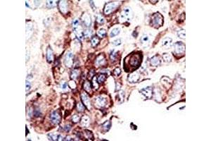 IHC analysis of FFPE human cancer tissue stained with the AXL antibody (AXL antibody  (AA 863-894))