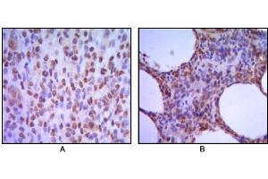 Immunohistochemical analysis of paraffin-embedded human melanoma (A), non-Hodgkin`s lymphoma (B), using MUM1 antibody with DAB staining.