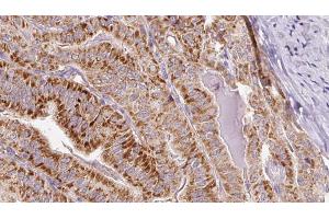 ABIN6267081 at 1/100 staining Human thyroid cancer tissue by IHC-P. (Connexin 43/GJA1 antibody  (pSer262))