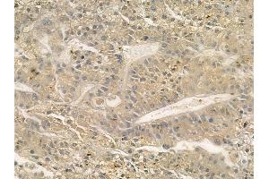 ABIN6262074 and ABIN6272312 at 1/100 staining human hepatocellular carcinoma by IHC-P. (GRAP antibody)