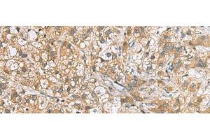 Immunohistochemistry of paraffin-embedded Human liver cancer tissue using DNPH1 Polyclonal Antibody at dilution of 1:60(x200) (RCL antibody)