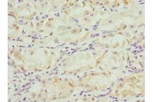 Immunohistochemistry of paraffin-embedded human gastric cancer using ABIN7153264 at dilution of 1:100 (FGD5 antibody  (AA 1203-1462))