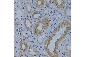 Immunohistochemistry of paraffin-embedded human kidney cancer using MVP Antibody (ABIN5971029) at dilution of 1/200 (40x lens).