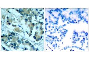 Immunohistochemical analysis of paraffin-embedded human lung carcinoma tissue, using MEK1 (Ab-217) antibody (E021203). (MEK1 antibody)