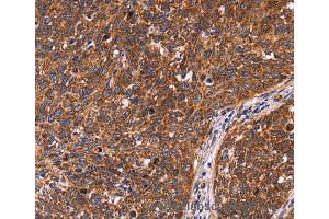 Immunohistochemistry of Human colon cancer using CCDC106 Polyclonal Antibody at dilution of 1:60 (CCDC106 antibody)