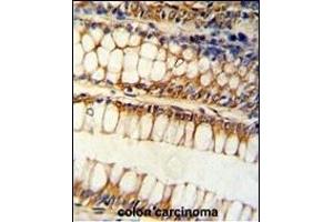 Formalin-fixed and paraffin-embedded human colon carcinoma reacted with BCL2L11 Antibody (Center), which was peroxidase-conjugated to the secondary antibody, followed by DAB staining. (BIM antibody  (AA 134-160))