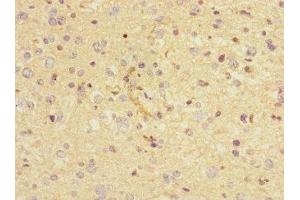 Immunohistochemistry of paraffin-embedded human glioma using ABIN7161350 at dilution of 1:100 (CHRNA9 antibody  (AA 26-240))
