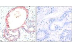 Immunohistochemistry analysis of paraffin-embedded human breast carcinoma, using Rel (Phospho-Ser503) Antibody. (c-Rel antibody  (pSer503))