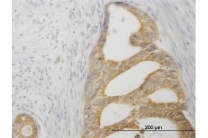 Immunoperoxidase of monoclonal antibody to TNFRSF14 on formalin-fixed paraffin-embedded human pancreatic cancer. (HVEM antibody  (AA 38-283))