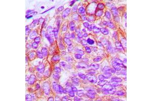 Immunohistochemical analysis of EGFR staining in human breast cancer formalin fixed paraffin embedded tissue section.