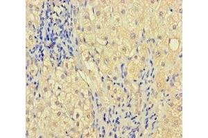 Immunohistochemistry of paraffin-embedded human liver cancer using ABIN7176291 at dilution of 1:100 (Zinc Finger Protein 44 antibody  (AA 1-300))