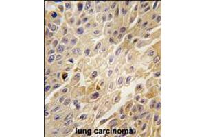 Formalin-fixed and paraffin-embedded human lung carcinoma tissue reacted with GRK2 Antibody , which was peroxidase-conjugated to the secondary antibody, followed by DAB staining. (GRK2 antibody  (C-Term))