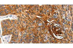 Immunohistochemistry of paraffin-embedded Human esophagus cancer tissue using AQP5 Polyclonal Antibody at dilution 1:40 (Aquaporin 5 antibody)