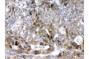 IHC testing of FFPE human liver cancer tissue with CYP2D6 antibody at 1ug/ml. (CYP2D6 antibody  (AA 315-347))