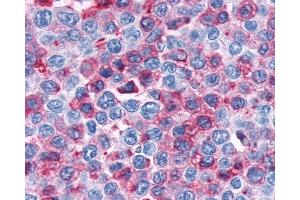 Anti-CNR1 / CB1 antibody IHC of human Lymph Node, Non-Hodgkins Lymphoma. (CNR1 antibody  (C-Term))