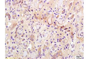 Formalin-fixed and paraffin embedded human kidney carcinoma labeled with Anti-phospho-IRS-1(Ser307) Polyclonal Antibody, Unconjugated (ABIN749873) at 1:200 followed by conjugation to the secondary antibody and DAB staining.