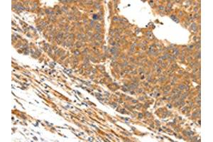 The image on the left is immunohistochemistry of paraffin-embedded Human liver cancer tissue using ABIN7190491(DOPEY1 Antibody) at dilution 1/25, on the right is treated with synthetic peptide. (DOPEY1 antibody)