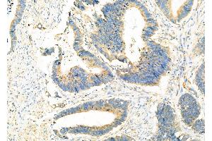 ABIN6265121 and ABIN6273320 at 1/100 staining Human colorectal cancer by IHC-P.