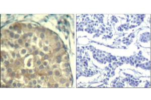 Immunohistochemical analysis of paraffin-embedded human breast carcinoma tissue using cofilin1/cofilin2 (phospho-Tyr88) Antibody (E011507). (Cofilin1/2 (CFL1/2) (pTyr88) antibody)