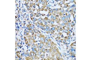 Immunohistochemistry of paraffin-embedded human lung cancer using OGDH antibody (ABIN5973793) at dilution of 1/100 (40x lens). (alpha KGDHC antibody)