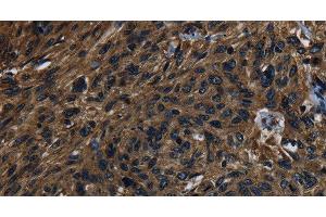 Immunohistochemistry of paraffin-embedded Human esophagus cancer using KLK14 Polyclonal Antibody at dilution of 1:40 (Kallikrein 14 antibody)