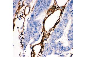 Anti- HSP27 antibody, IHC(P) IHC(P): Human Intestinal Cancer Tissue (HSP27 antibody  (AA 1-205))