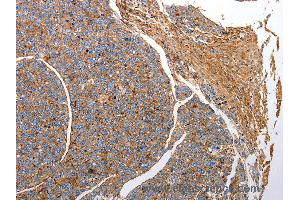 Immunohistochemistry of Human liver cancer using CD151 Polyclonal Antibody at dilution of 1:25 (CD151 antibody)