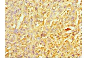 Immunohistochemistry of paraffin-embedded human melanoma using ABIN7151313 at dilution of 1:100 (XIAP antibody  (AA 1-200))