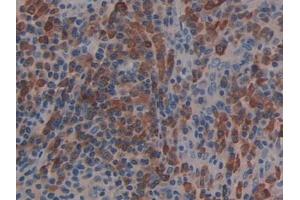 Detection of LAT2 in Human Skin cancer Tissue using Polyclonal Antibody to Linker For Activation Of T-Cells Family, Member 2 (LAT2) (LAT2 antibody  (AA 30-209))