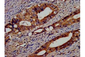 IHC image of ABIN7152156 diluted at 1:400 and staining in paraffin-embedded human colon cancer performed on a Leica BondTM system. (EIF3G antibody  (AA 2-320))