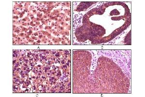 Immunohistochemical analysis of paraffin-embedded human liver tissue (A), colon carcinoma (B), lung carcinoma (C) and esophagus tissue (D), showing membrane localization using CK1 antibody with DAB staining. (CSNK1A1 antibody)