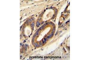 ATP6V0B Antibody (Center) immunohistochemistry analysis in formalin fixed and paraffin embedded human prostate carcinoma followed by peroxidase conjugation of the secondary antibody and DAB staining. (ATP6V0B antibody  (Middle Region))