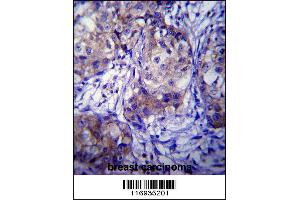CYP1A1 Antibody immunohistochemistry analysis in formalin fixed and paraffin embedded human breast carcinoma followed by peroxidase conjugation of the secondary antibody and DAB staining. (CYP1A1 antibody  (AA 252-280))