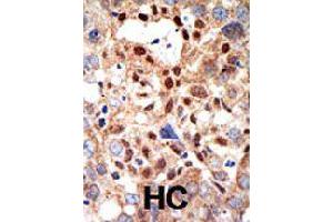 Formalin-fixed and paraffin-embedded human hepatocellular carcinoma tissue reacted with PML polyclonal antibody  , which was peroxidase-conjugated to the secondary antibody, followed by DAB staining .
