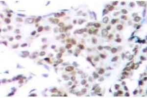Immunohistochemistry (IHC) analyzes of p-STAT3 (pSer727) pAb in paraffin-embedded human breast carcinoma tissue. (STAT3 antibody  (pSer727))