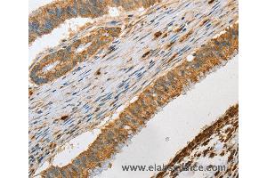 Immunohistochemistry of Human colon cancer using GZMB Polyclonal Antibody at dilution of 1:30 (GZMB antibody)